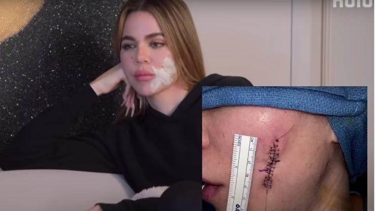 La estrella de Internet reveló cómo lucía su rostro tras la eliminación de un melanoma